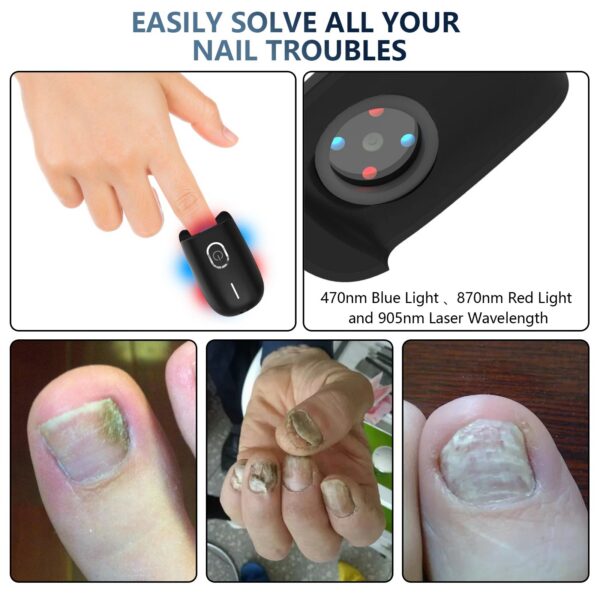 KTS Nail Fungus Laser Device Toenail Laser Therapy Machine Anti Fungal Laser Equipment for Onychomycosis 910nm 407nm USB Charge