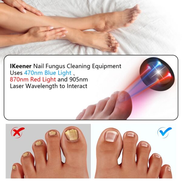 KTS Nail Fungus Laser Device Toenail Laser Therapy Machine Anti Fungal Laser Equipment for Onychomycosis 910nm 407nm USB Charge