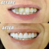 abdf4249d3278f01 New False Silicone Upper & Lower Perfect Laugh Veneers Dentures Paste Fake Braces Comfortable Teeth